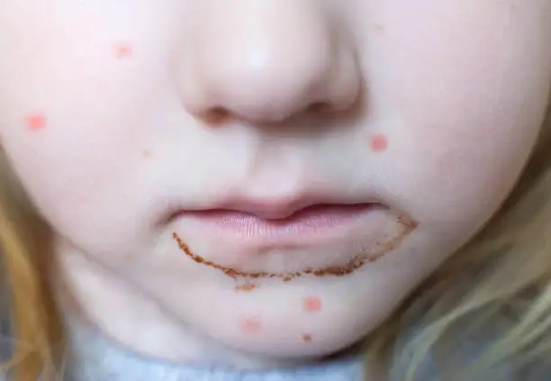 Child skin and mouth symptoms visual for skin hair and mouth changes